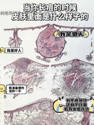 皮肤爆痘留印又留坑的真相